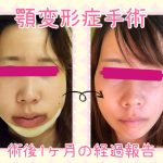 顎変形症手術から1ヶ月　顔の腫れの変化